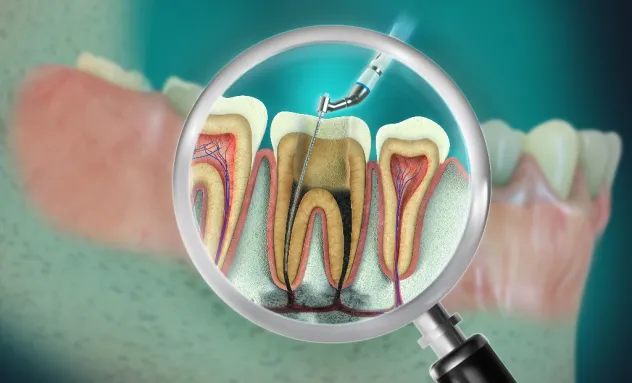 Root canal file left in tooth after procedure
